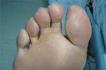 sudoración del pie